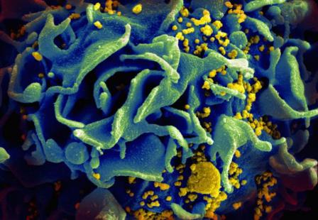 Particules du VIH (jaune) à la surface d'un lymphocyte T. Microscopie Électronique à Balayage (MEB).
