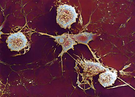 Destruction des oligodendrocytes de chaque cellule gliale (rond) due à une sclérose en plaques.